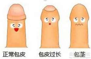 男科切除包皮一般多少钱